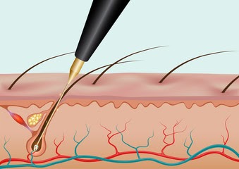 PDF White Hair Removal with Follicular Unit Extraction