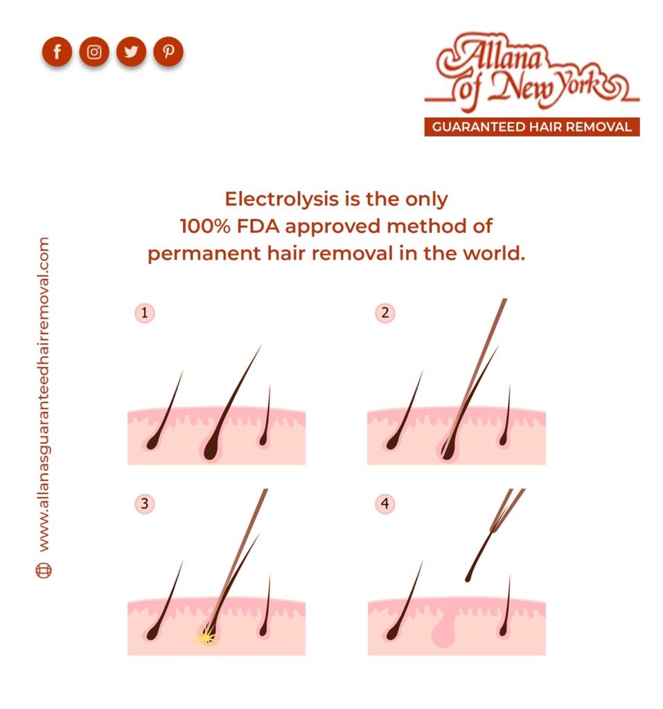 electrolysis hair removal - allana of newyork